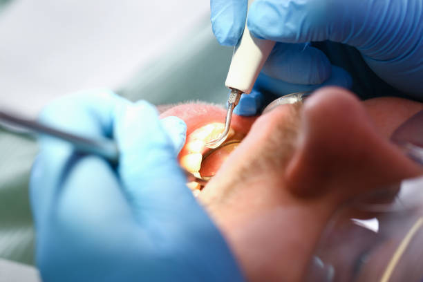 Best Emergency Tooth Extraction in Mbria, CA