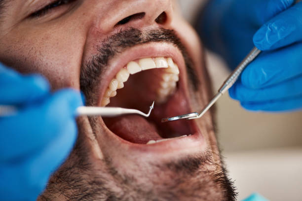 Best Emergency Dental Care for Broken or Chipped Teeth in Mbria, CA